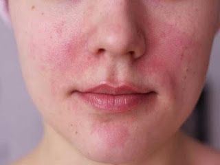 Piel sensible: ¿cómo identificarla y cuidarla?
